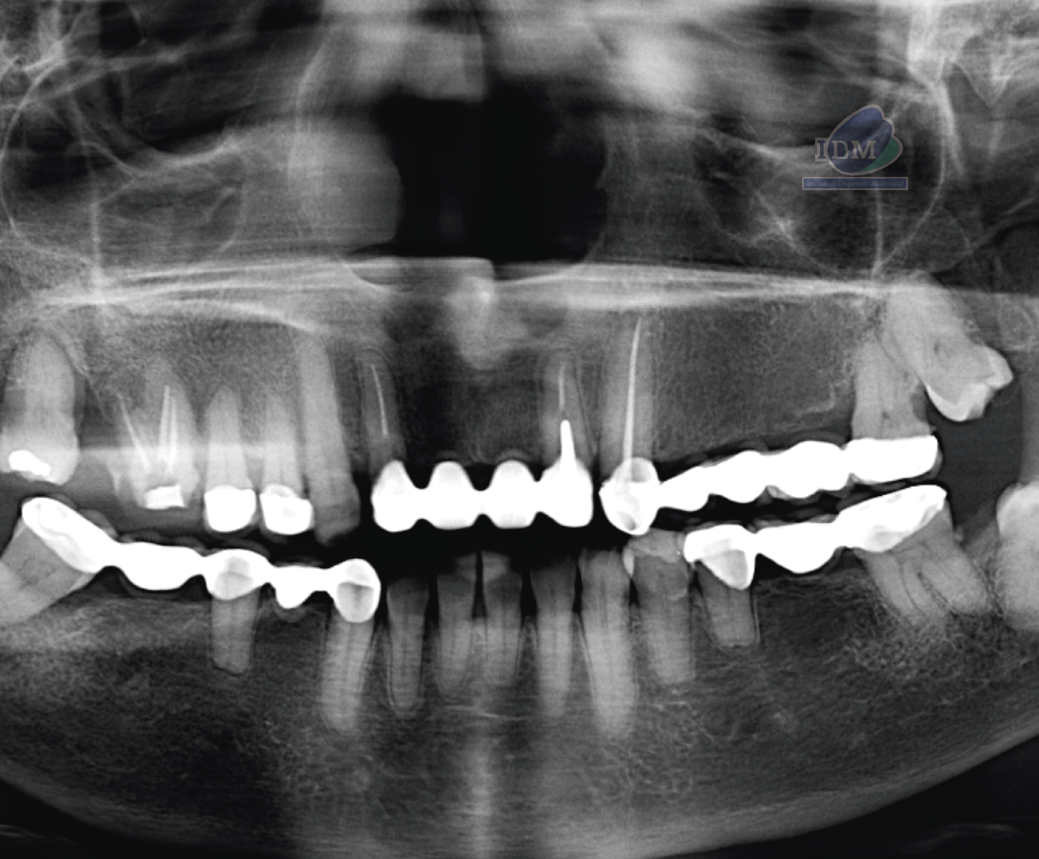 CASO 354 - RADIOGRAFIA PANORAMICA 02 IDM_Rad Pan 01