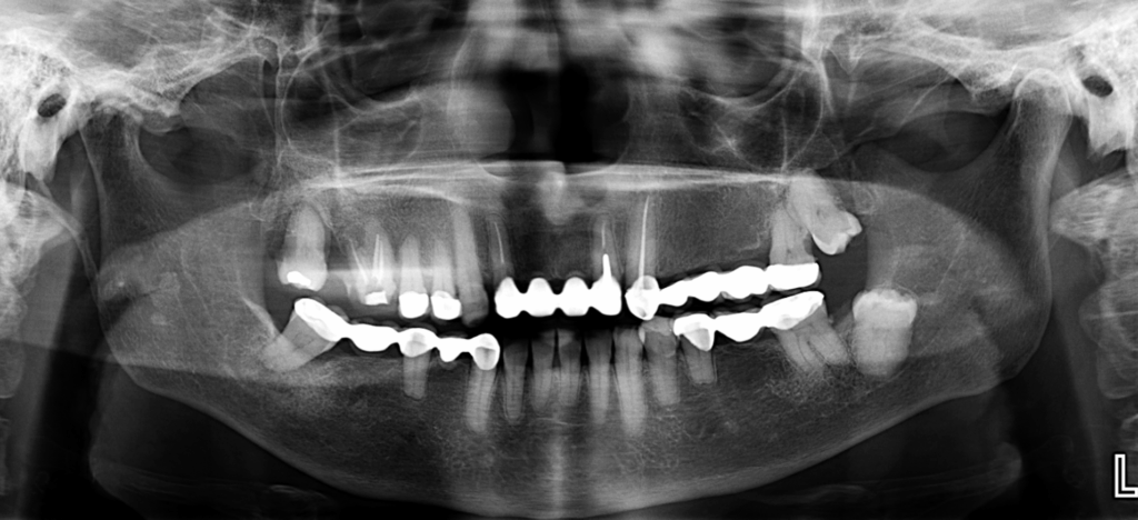 CASO 354 - RADIOGRAFIA PANORAMICA IDM