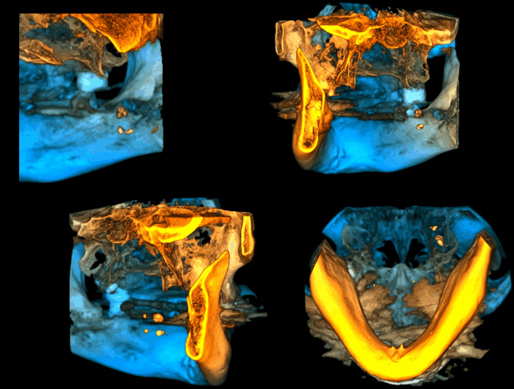 CASO 354 - RECONSTRUCCION 3D IDM
