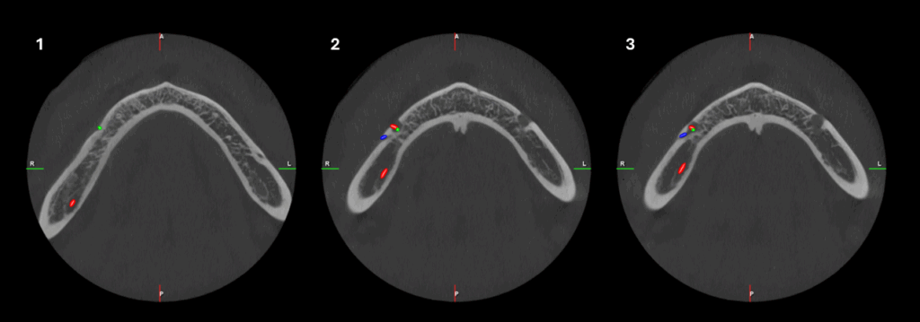 Caso 348 - Cortes Axiales