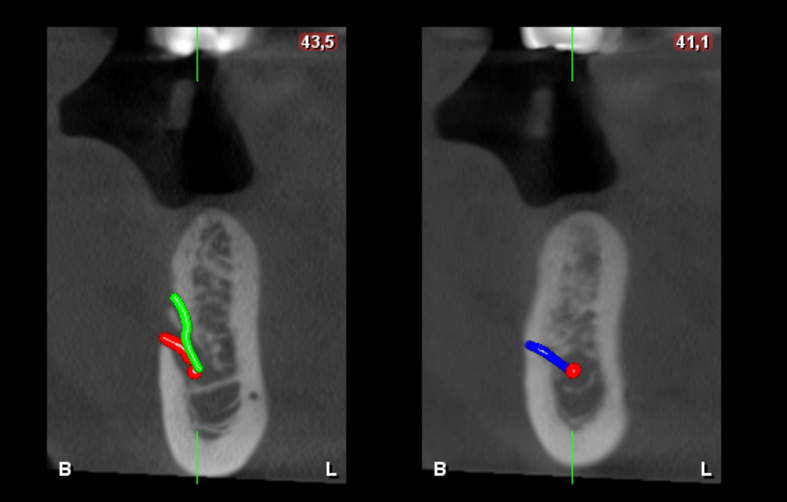 Caso 348 - Cortes Transaxiales