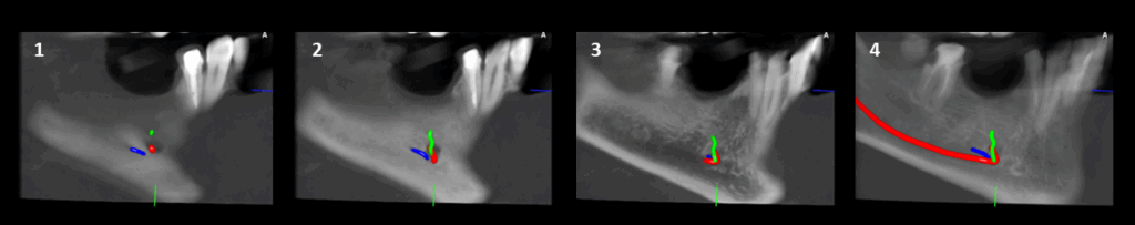 Caso 348 - Cortes tangenciales