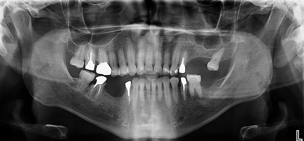 Caso 348 - Radiografía Panorámica