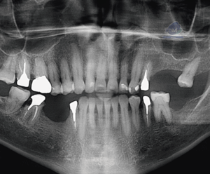 Caso 348 - Radiografía Panorámica v02_Rad Pan 01