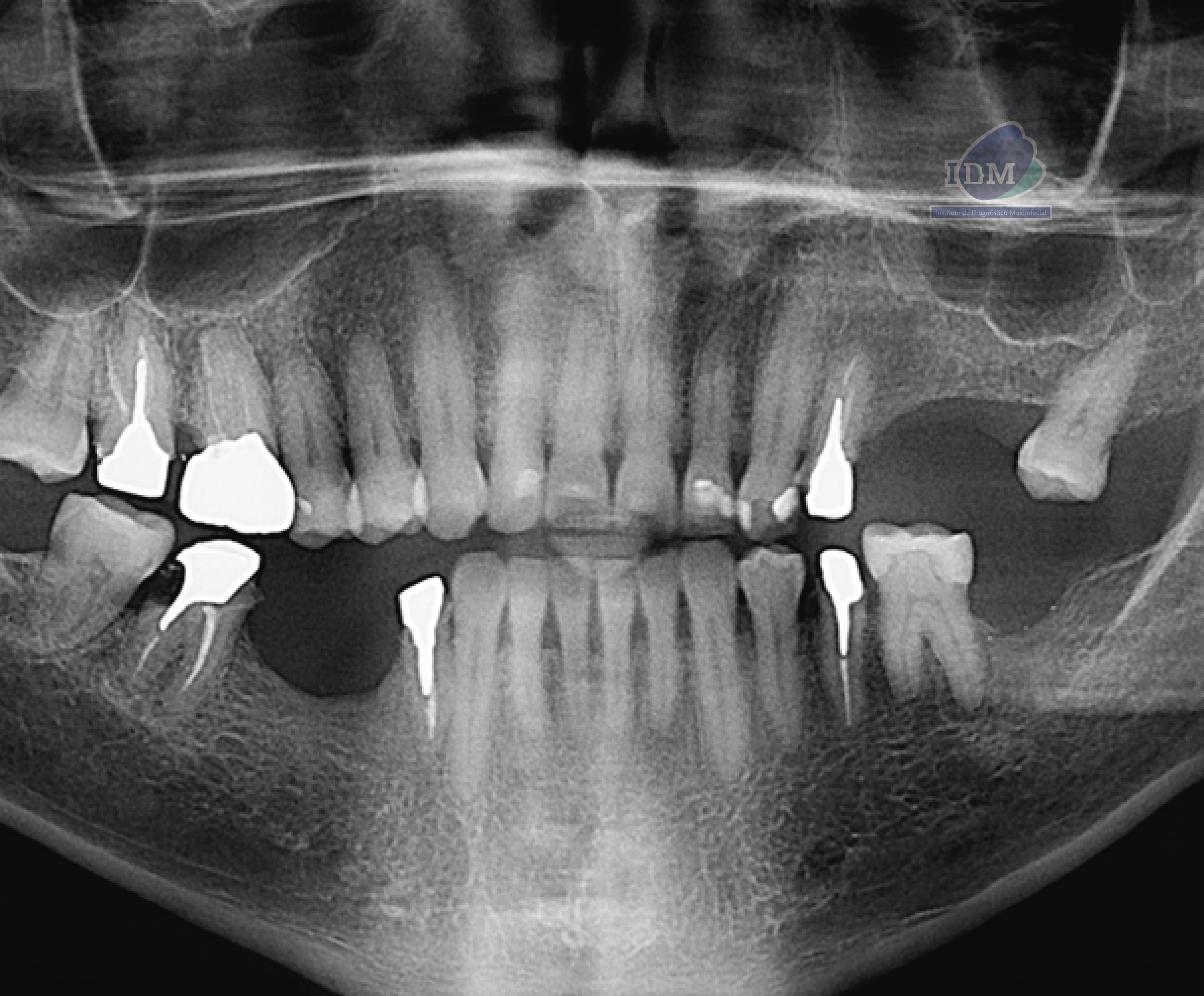 Caso 348 - Radiografía Panorámica v02_Rad Pan 01