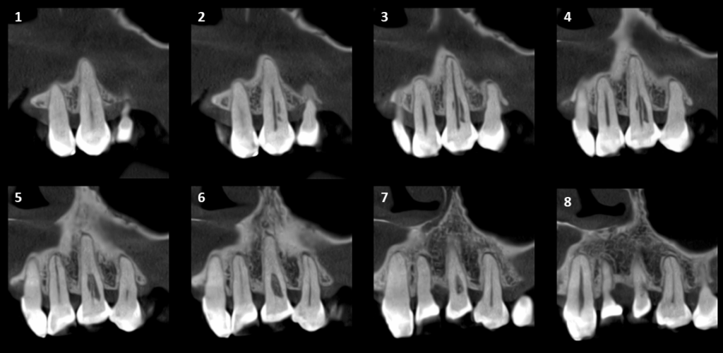 Caso 349 - Cortes Tangenciales