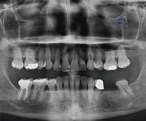 Caso 349 - Radiografía Panorámica 02_Rad Pan 01
