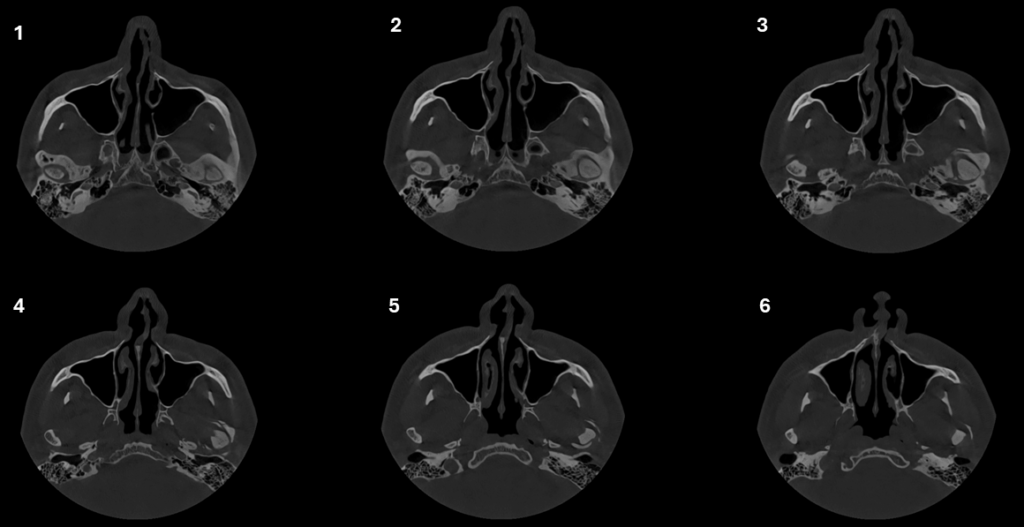 Caso 350 - Cortes Axiales