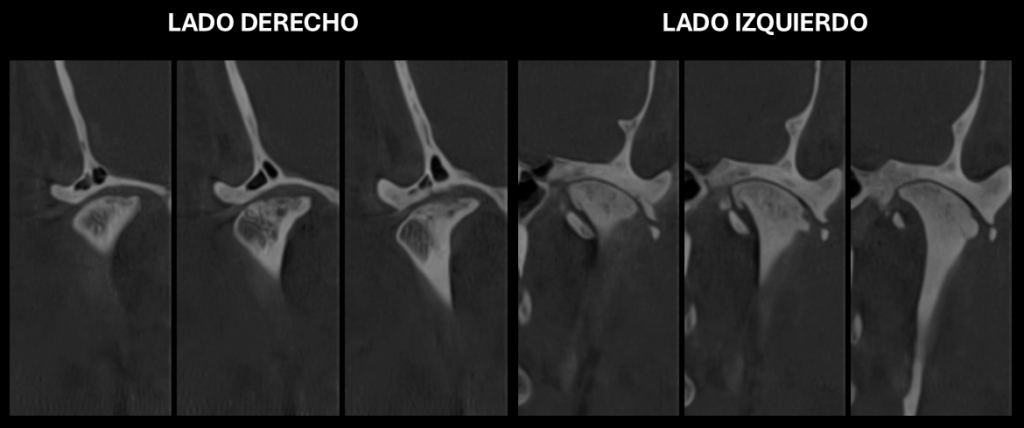 Caso 350 - Cortes Coronales Oblicuos