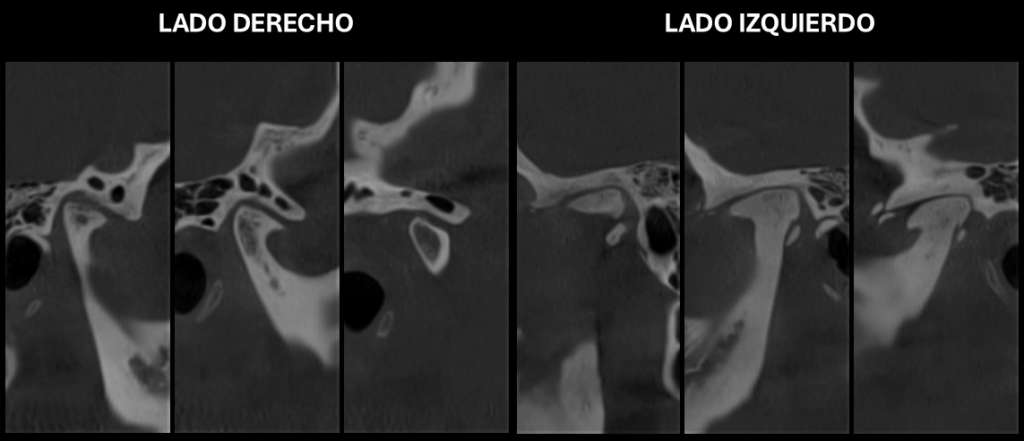 Caso 350 - Cortes Sagitales Oblicuos