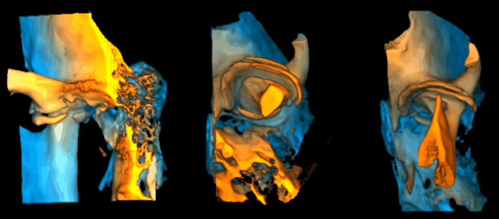 Caso 350 - Reconstruccion 3d 02