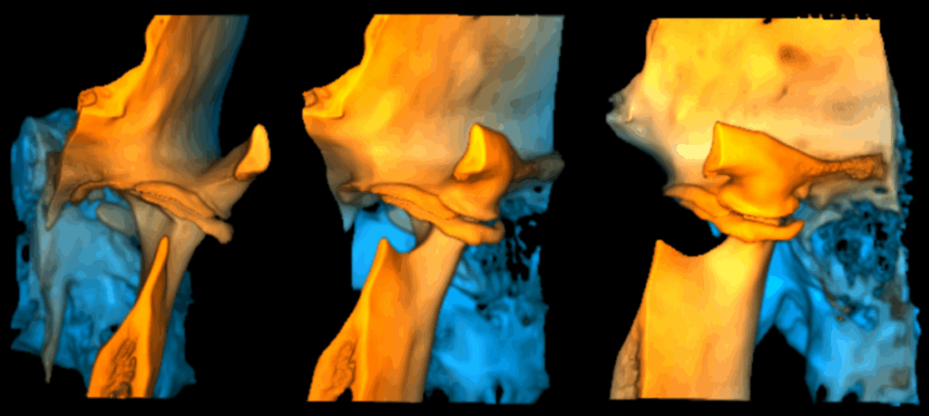 Caso 350 - Reconstruccion 3d