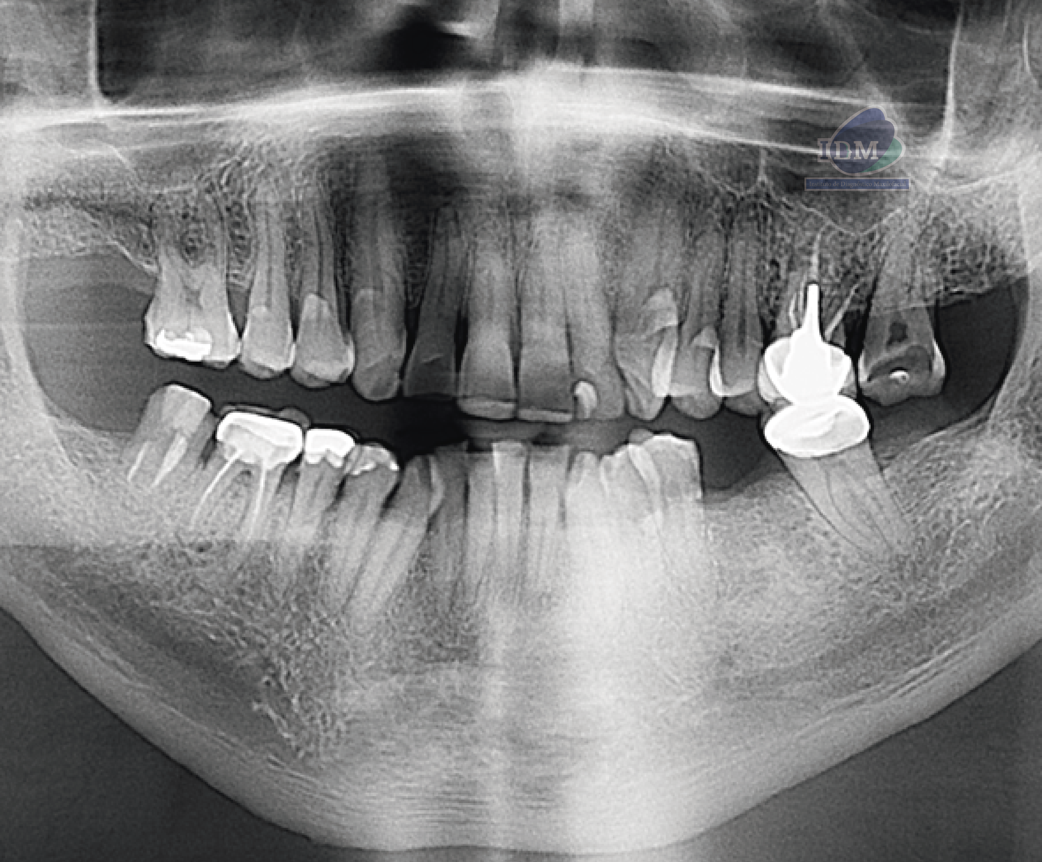 Caso 350 - Rediografia Panoramica 02_Rad Pan 01