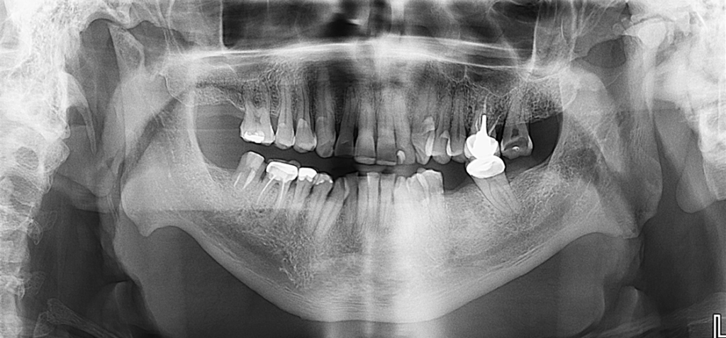 Caso 350 - Rediografia Panoramica
