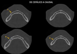Caso 351 - Cortes Axiales
