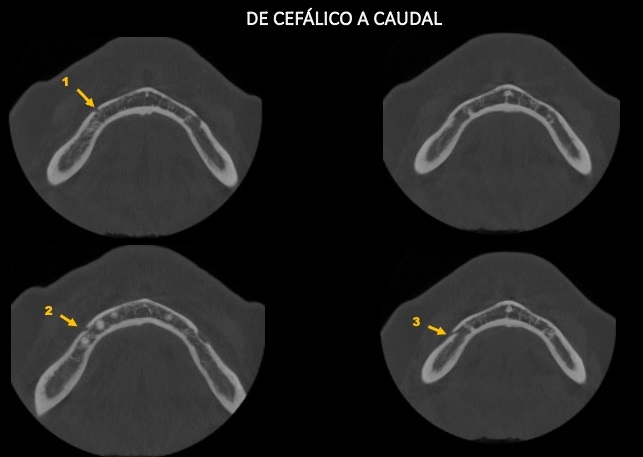 Caso 351 - Cortes Axiales