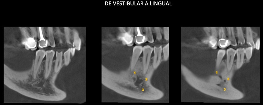Caso 351 - Cortes Tangenciales