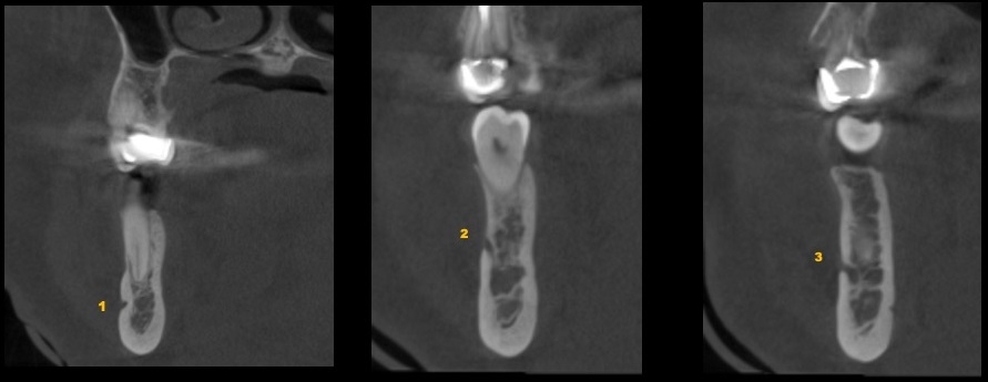 Caso 351 - Cortes Transaxiales