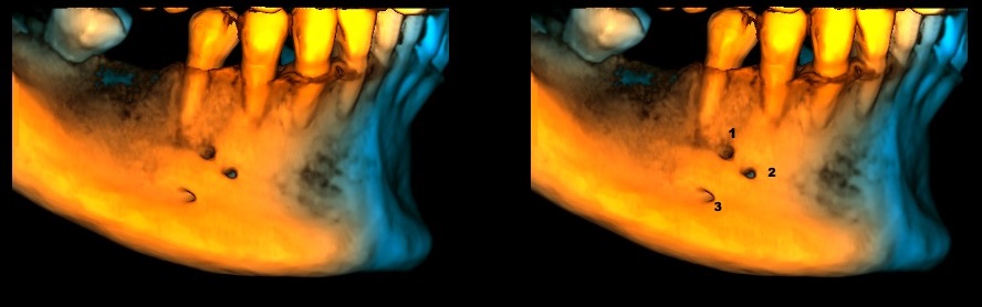 Caso 351 - Reconstruccion 3D