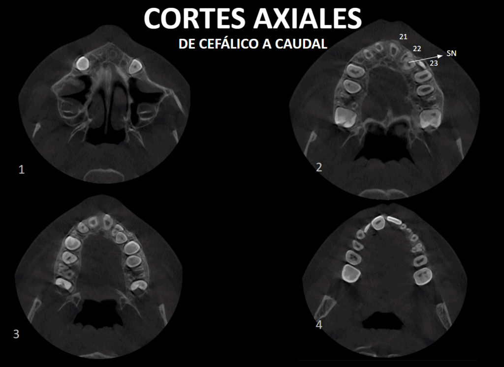 caso 343 - CORTES AXIALES 01 IDM