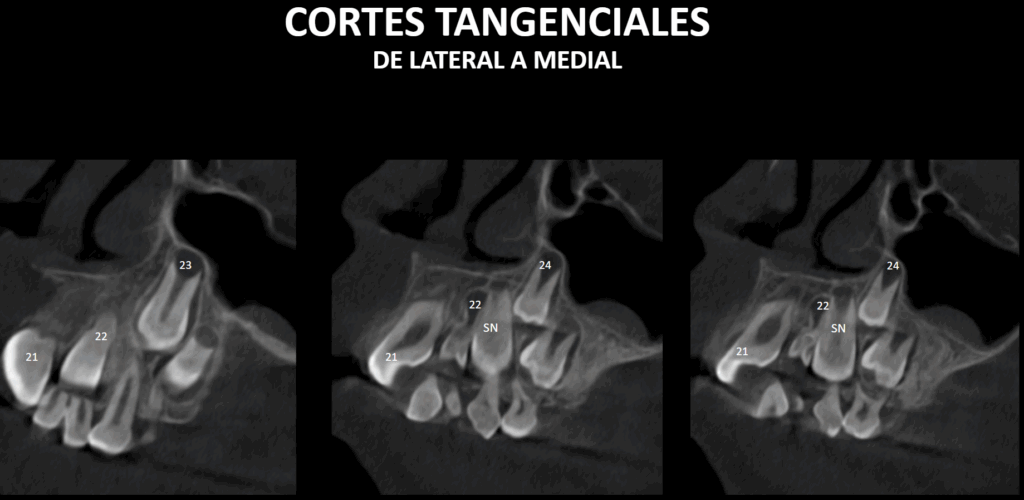 caso 343 - CORTES TANGENCIALES IDM