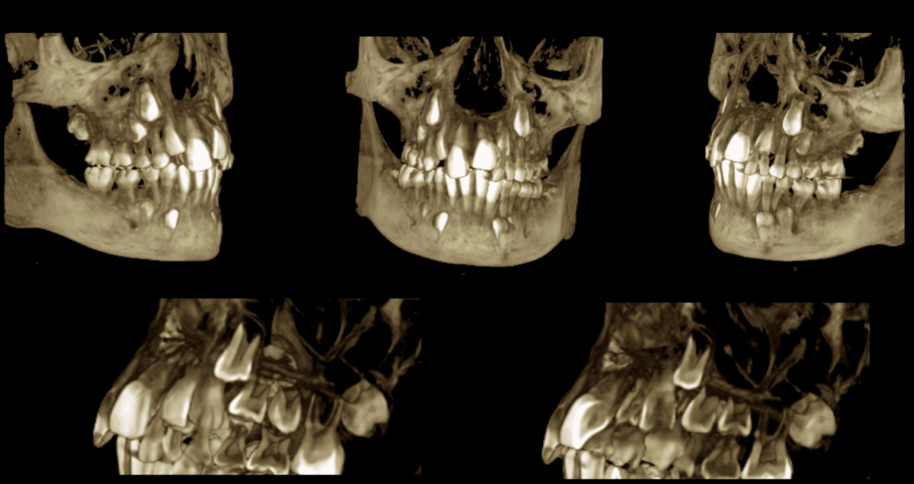 caso 343 - RECONSTRUCCION 3D IDM