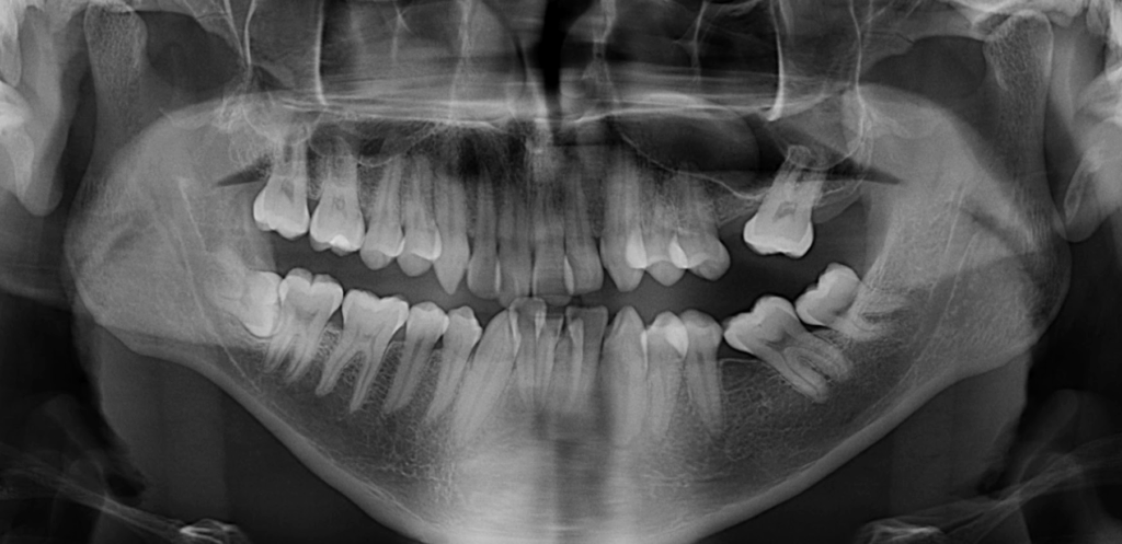 caso 344 - radiografia panoramica 01 IDM