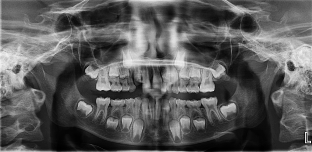 caso 343 - radiografia panoramica 01 IDM