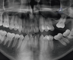 caso 344 - radiografia panoramica 02 IDM_Rad Pan 01