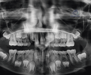 caso 343 - radiografia panoramica 02 IDM_Rad Pan 01