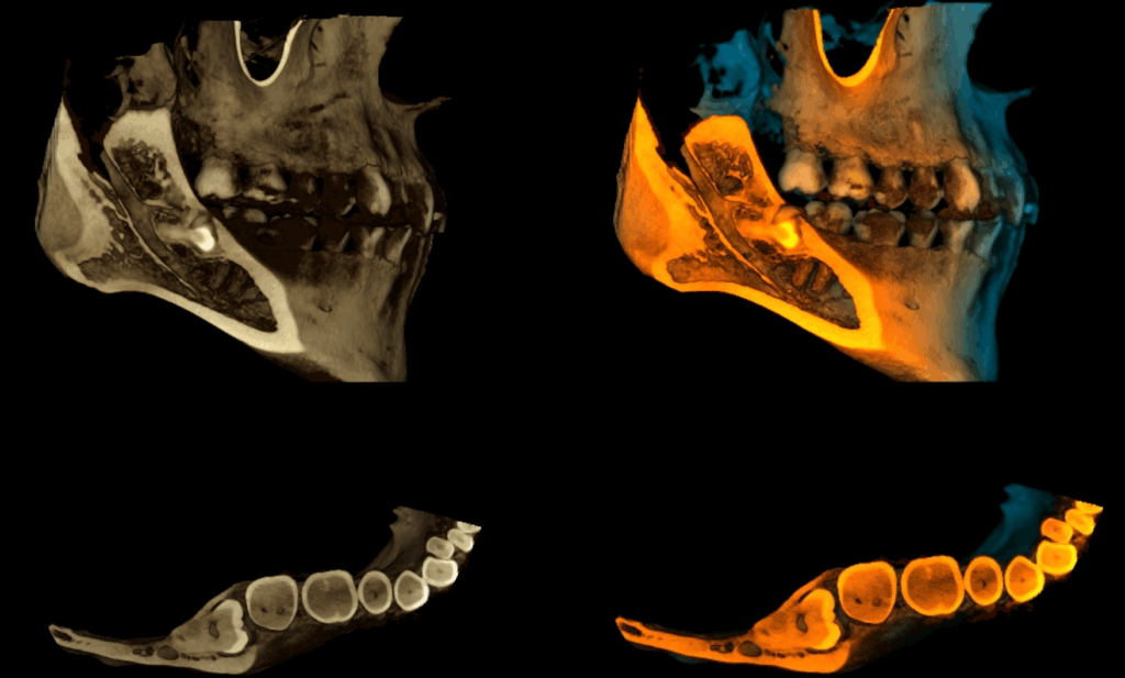 caso 344 - RECONSTRUCCION 3D IDM