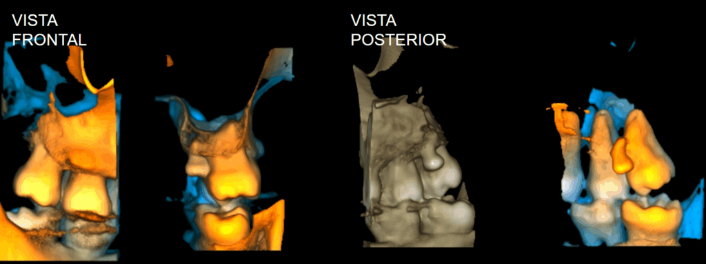 caso 345 - RECONSTRUCCION 3D IDM