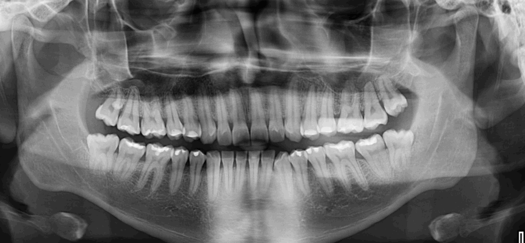 caso 345 - radiografia panoramica 01 IDM