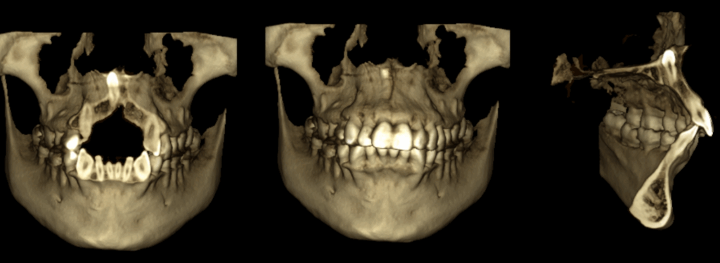 caso 346 - RECONSTRUCCION 3D IDM