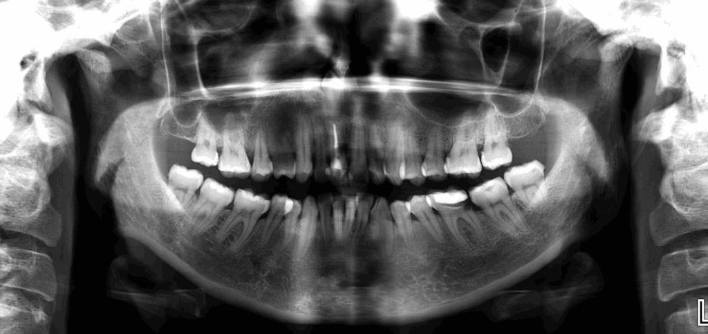 caso 346 - radiografia panoramica 01 IDM