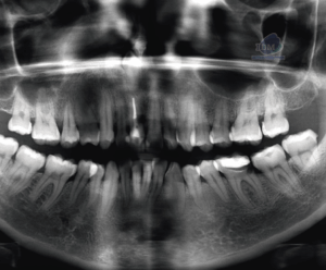 caso 346 - radiografia panoramica 02 IDM_Rad Pan 01