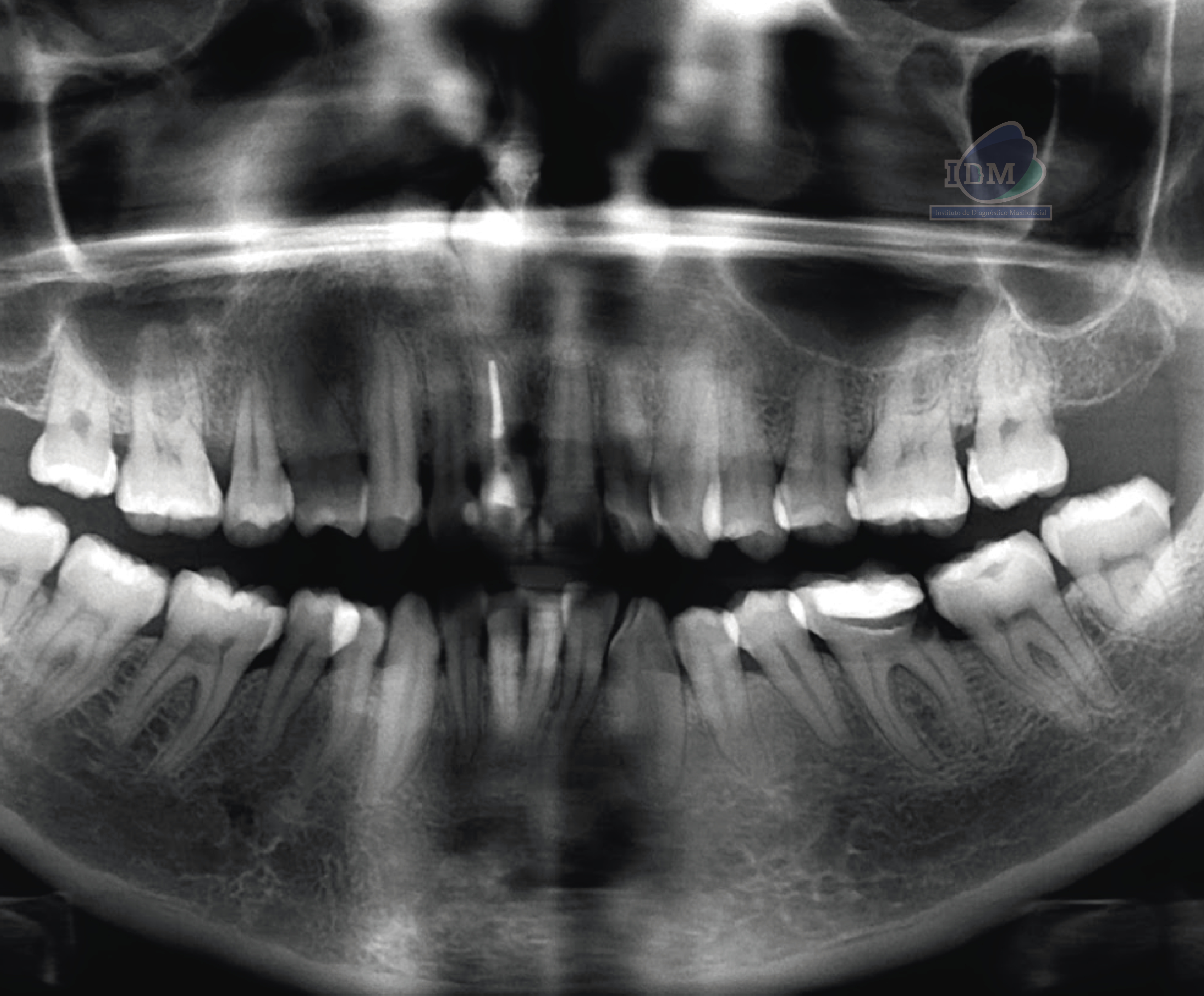 caso 346 - radiografia panoramica 02 IDM_Rad Pan 01