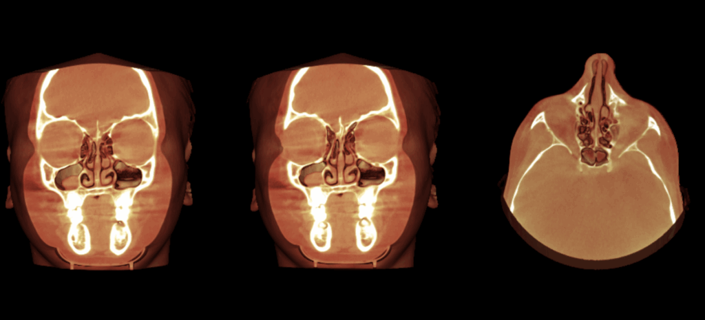caso 347 - RECONSTRUCCION 3D IDM_Rad Pan 01