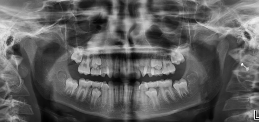 caso 347 - radiografia panoramica 01 IDM