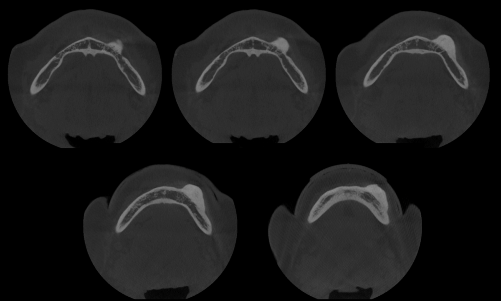 Caso 1 256 - Cortes Axiales IDM