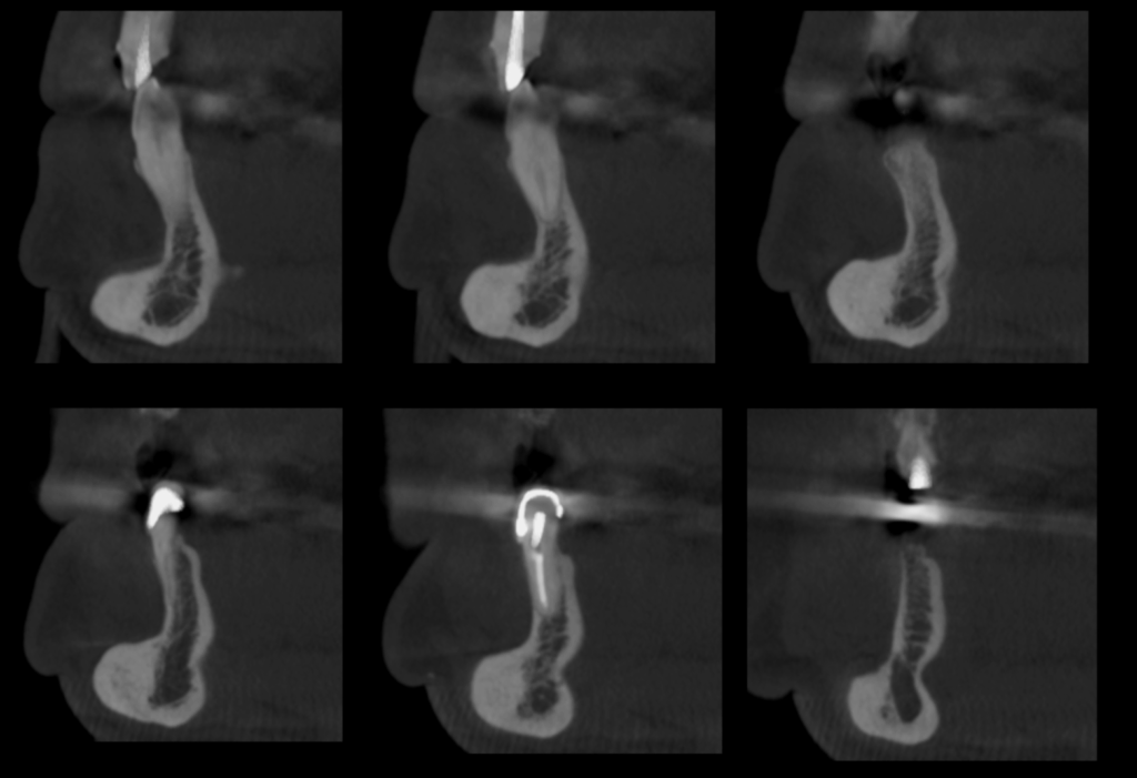 Caso 1 256 - Cortes Sagitales IDM