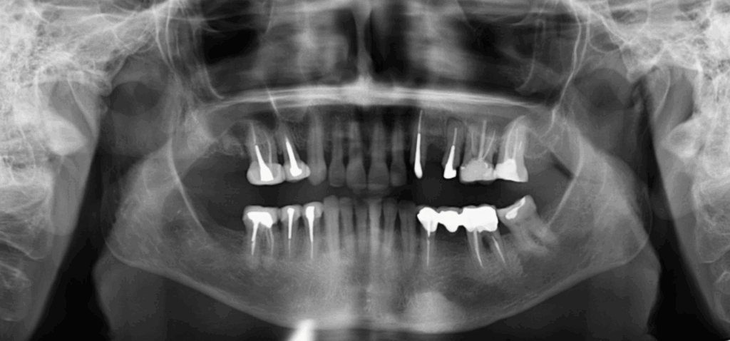 Caso 1 256 - Radiografia Panorámica IDM