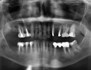Caso 1 256 - Radiografia Panorámica IDM 2