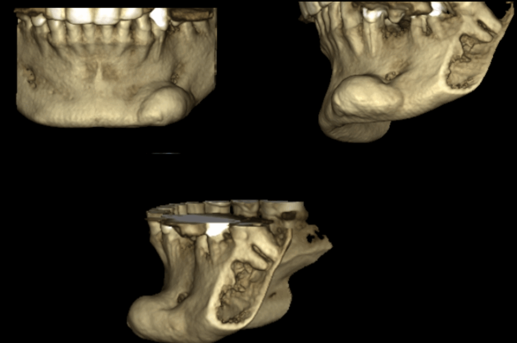 Caso 1 256 - Reconstrucción 3D IDM