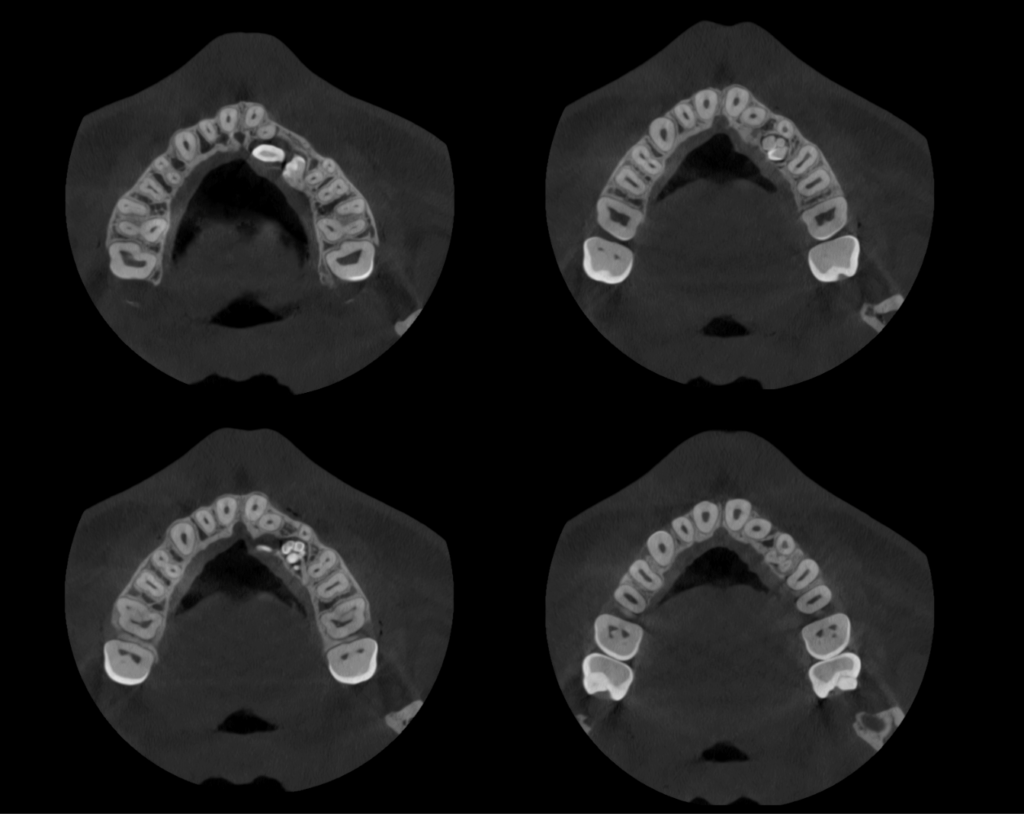 Caso 258 - Cortes Axiales IDM