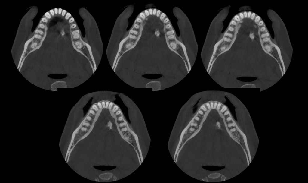 Caso 356 Cortes Axiales - IDM