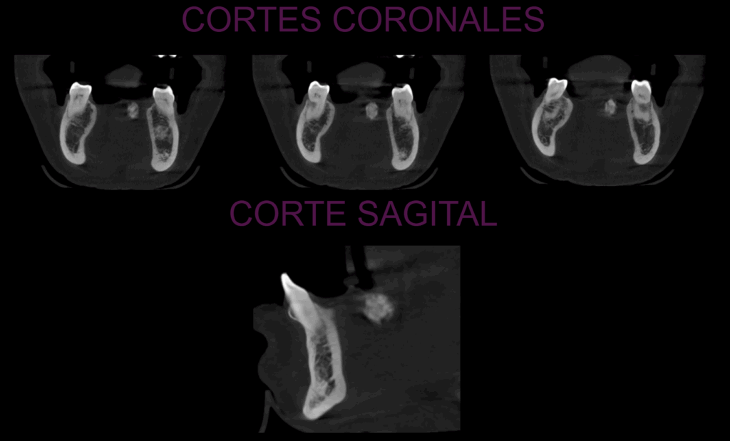 Caso 356 Cortes coronales y axiales - IDM