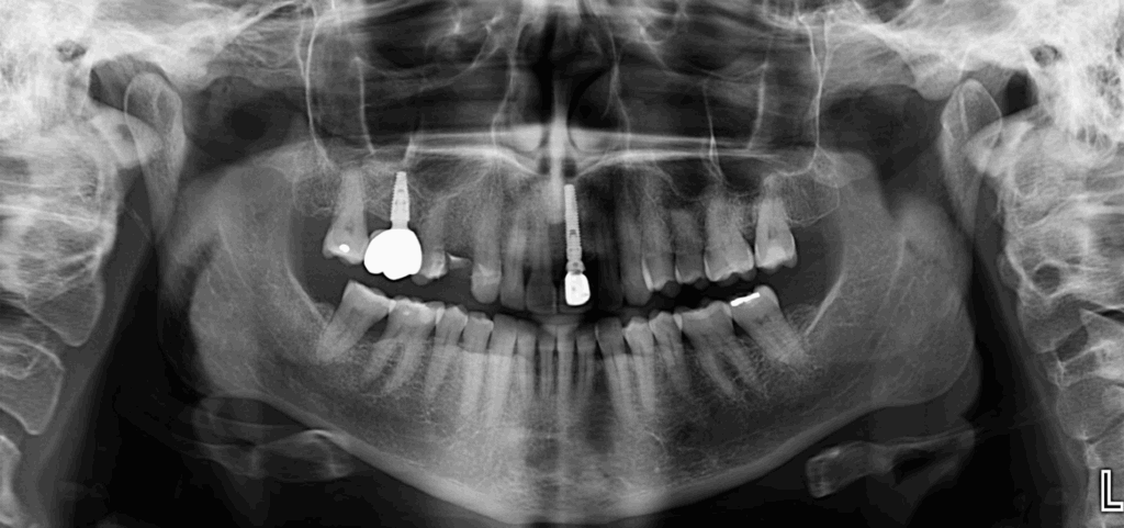 Caso 356 Radiografía panorámica - IDM