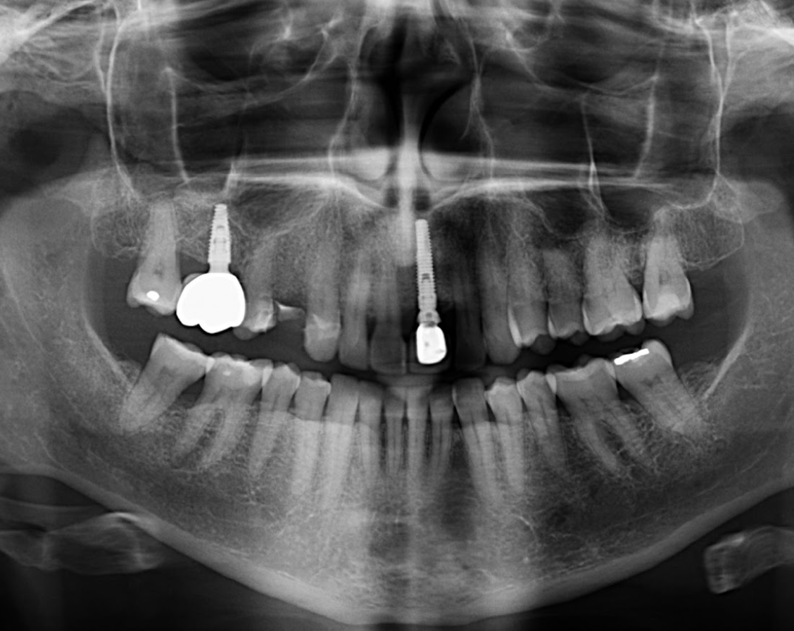 Caso 356 Radiografía panorámica - IDM 2