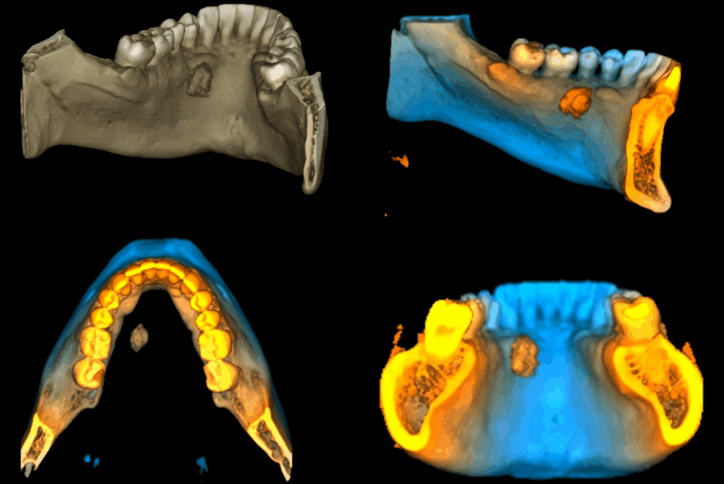 Caso 356 Reconstruccion 3D - IDM